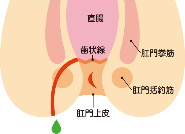 痔ろう（穴痔）